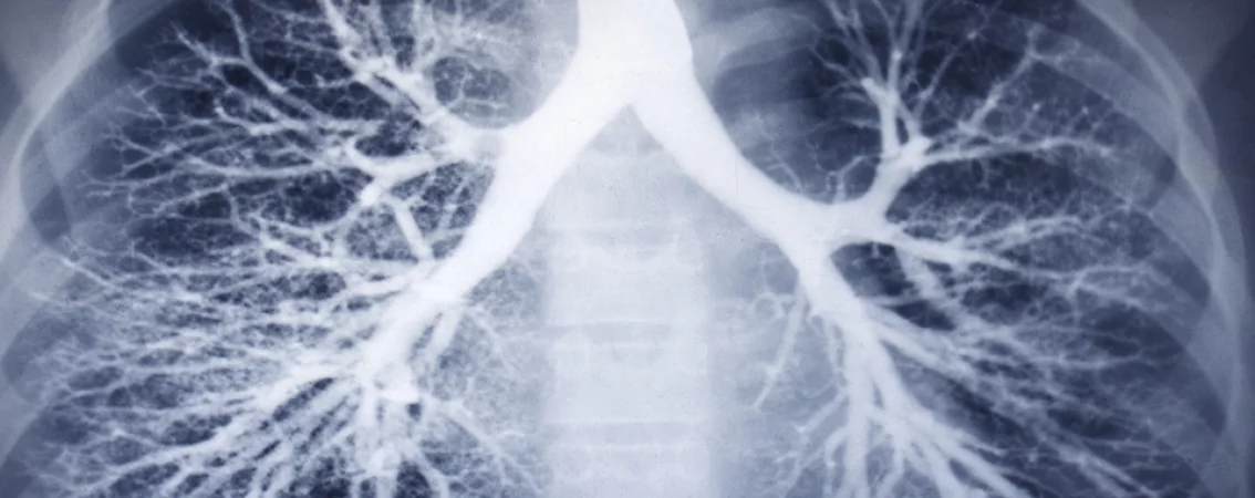 CT pulmonális angiográfia
