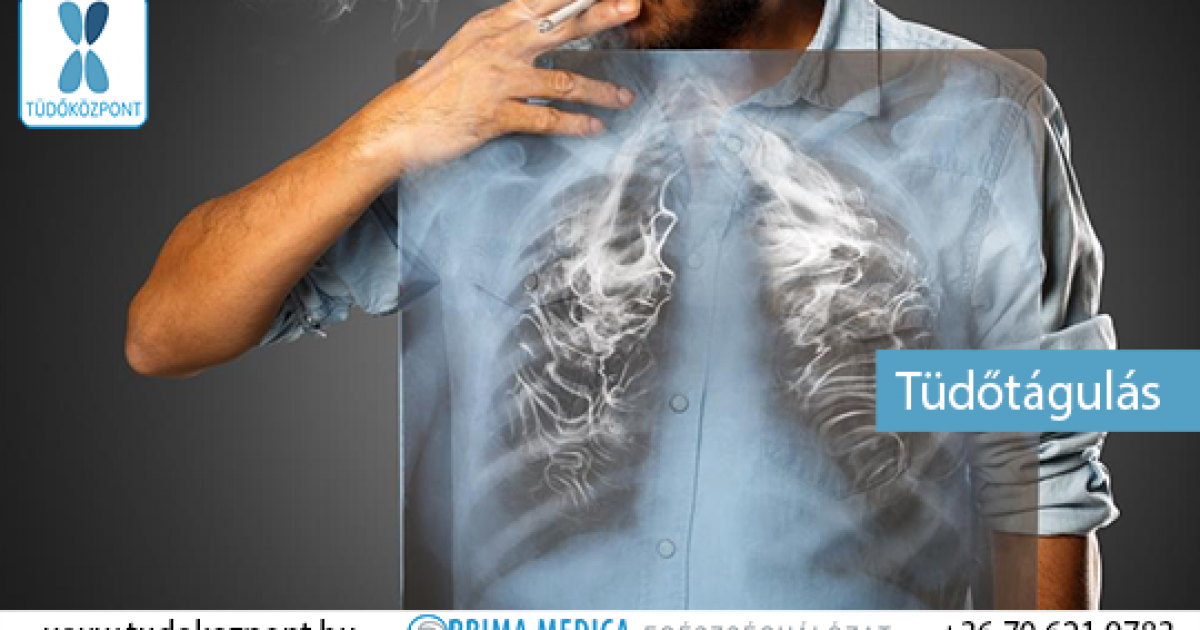 Tüdőtágulat: az emfizéma és tünetei