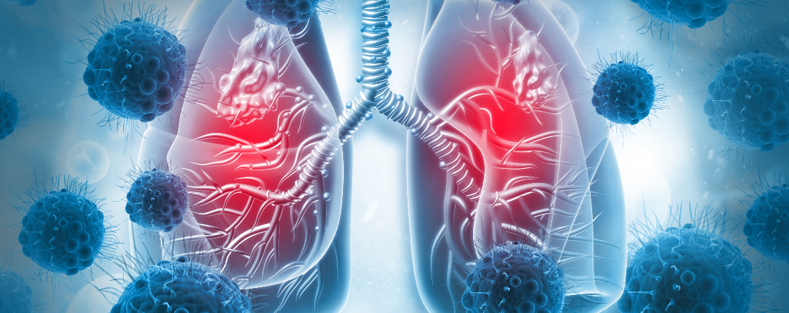 Az új Covid variánsok szövődménye ritka esetben akár tüdőgyulladás is lehet