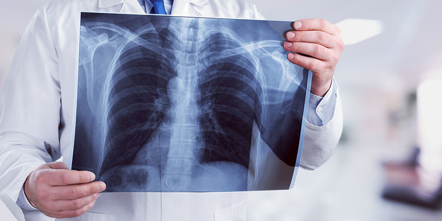 a tüdőgyulladás súlyos fogyást okozhat