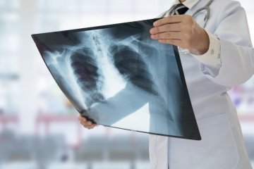 Tüdőgyulladás: influenza szövődménye is lehet
