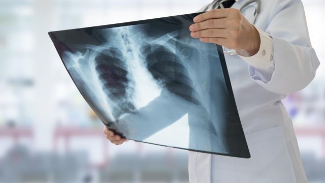 Tüdőgyulladás: influenza szövődménye is lehet