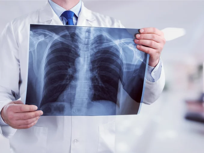 Tények és tévhitek a tüdőgyulladás tüneteiről és kezeléséről