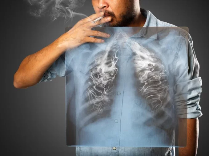Tüdőtágulás: legtöbbször dohányzással kezdődik