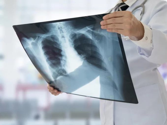 Sokarcú betegség: november 15. a COPD Világnapja