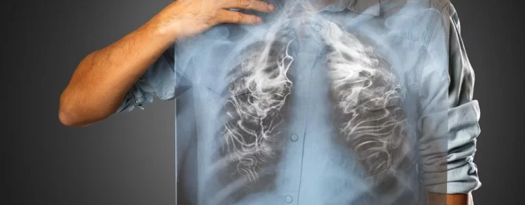 Tüdőtágulás: legtöbbször dohányzással kezdődik