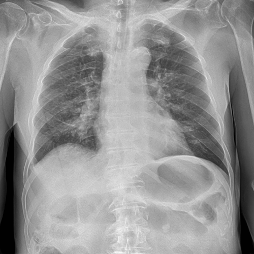 Tüdőgyulladás diagnózisa