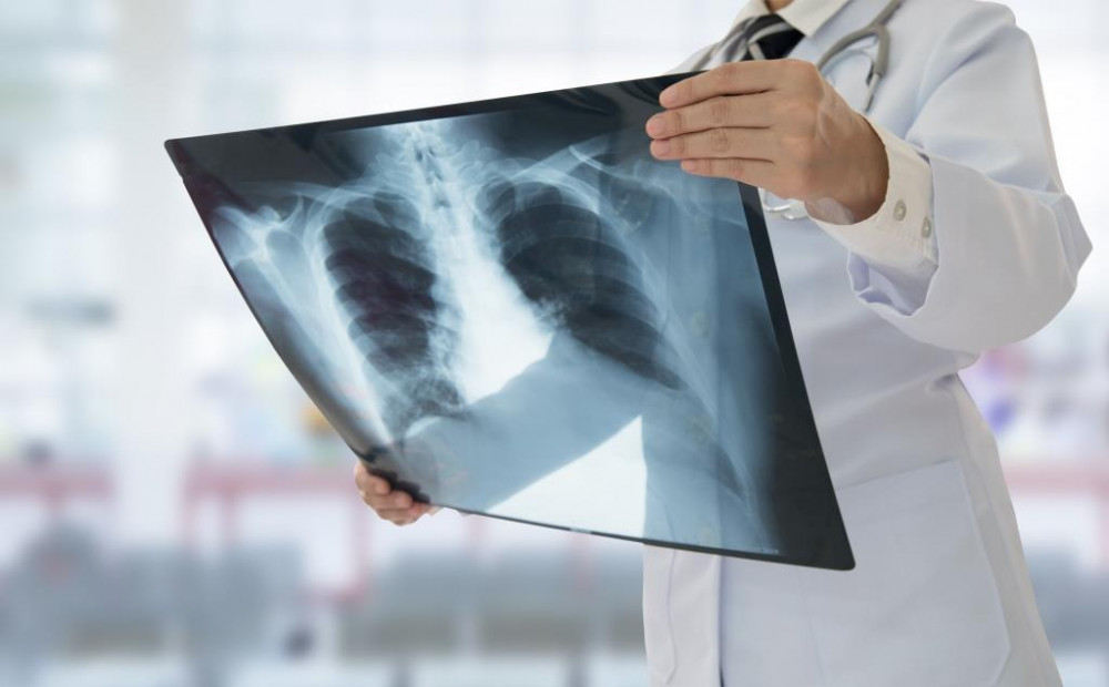 tüdőgyulladás röntgen